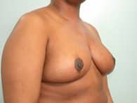 A patient's right-angle shows her breasts and arm after the surgery.