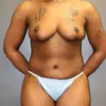 View from the front of a woman patient in a white bikini after surgery, revealing her breasts, tummy, and legs