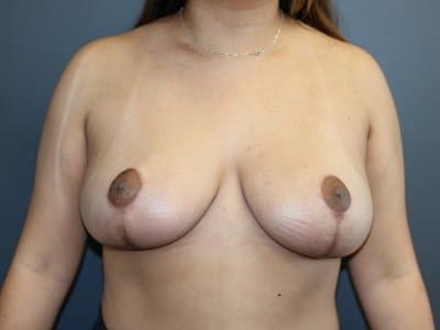 The patient is shown in a left-angle view of her breast, abdomen and arm after surgery.