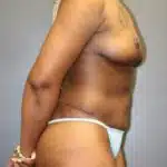 Post-surgery appearance of a female patient's right side, showcasing breast, flat tummy, and legs