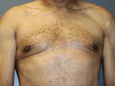 The patient's chest and abdomen are shown from the front after the surgery.