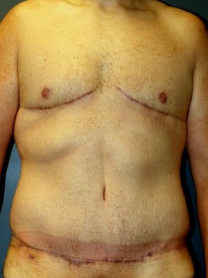 A frontal angle of the patient's chest and abdomen post-surgery at Perimeter Plastic Surgery.