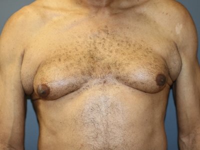 A patient's chest, upper abdomen, and arms before surgery.
