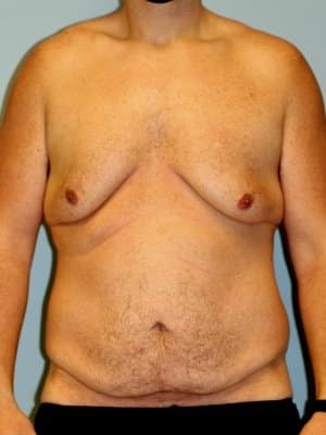 A front view of a patient man shows his chest, abdomen, and arms before surgery