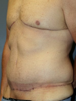 A patient's right angle of his body after the surgery