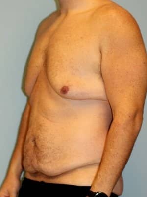 A patient's body at a left angle shows his chest and abdomen before surgery.