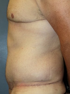 A post-surgery of a patient's left breast, abdomen, and arm