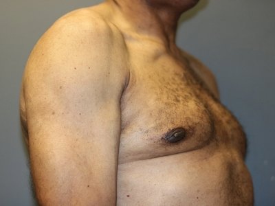 A patient's right-angle view of his chest and arm after the surgery