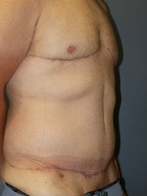 A patient's right-angle body shows his successful chest and abdomen after the surgery.