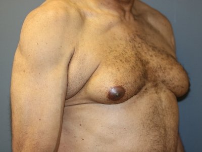 A patient's preoperative right-angle of his chest and abdomen.