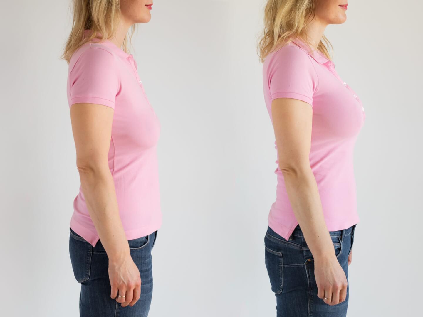 Pink-shirted patient showcasing the transformation in breast appearance from before to after lift surgery