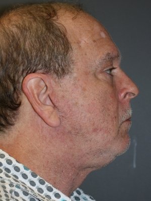 A man's right view of his face after the facelift surgery