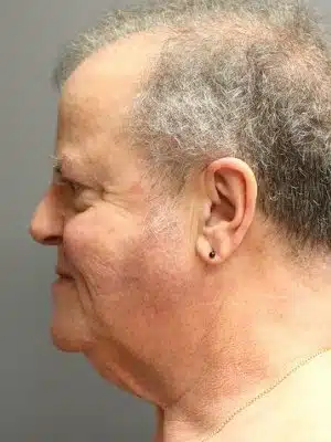 Patient's left profile prior to facelift surgery