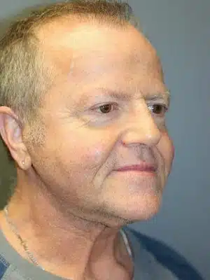 A face of a patient at a right angle after face lift surgery.