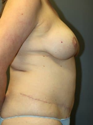 A patient's right view of her breast and tummy after the surgery
