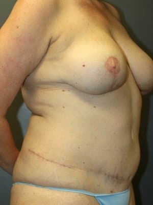 Post-surgery showing a patient's right-angle view following tummy tuck and breast surgery