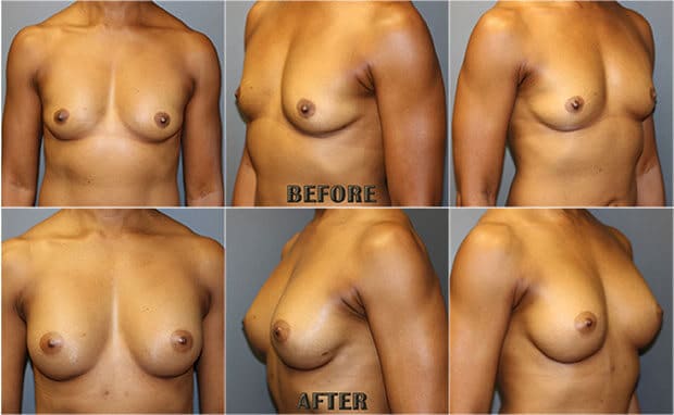 Breast Augmenation Before After Images