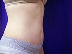 Right-angle view of a woman patient's flat abdomen while wearing undergarments.