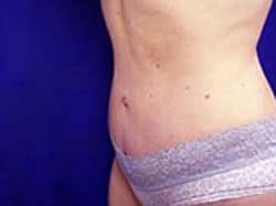 A patient woman is shown wearing underwear after her surgery from a right-angled view of her abdomen.