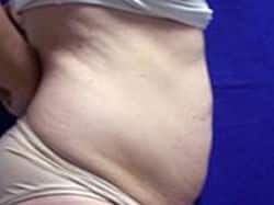 A patient's right-angle of her abdomen before the surgery.