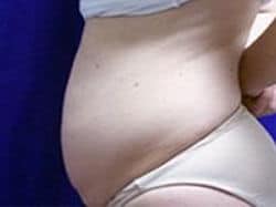 A patient's abdomen to the left side before the abdominoplasty procedure.
