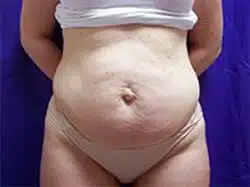 A front angle of the patient's abdomen before a tummy tuck surgery