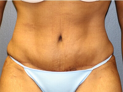 A frontal view of a patient wearing a bikini post-tummy tuck surgery