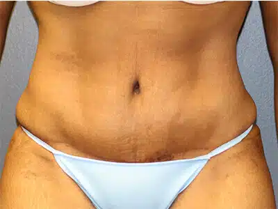 A frontal view of a patient wearing a bikini post-tummy tuck surgery