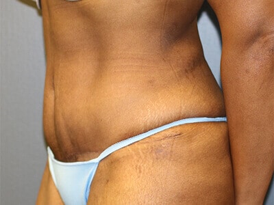 A patient's right angle of her abdomen after the surgery