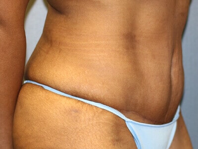 A patient's right-angle of the lower abdomen wearing a light blue bikini after the surgery.