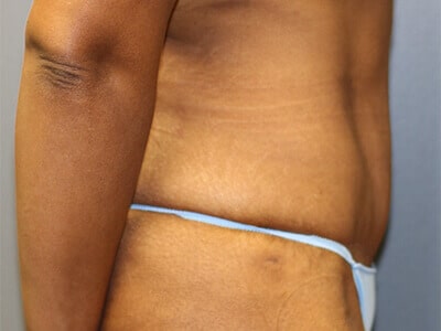 A patient's abdomen and an arm in the right view