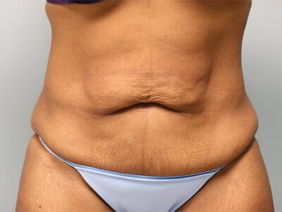A patient woman's saggy tummy before the tummy tuck surgery