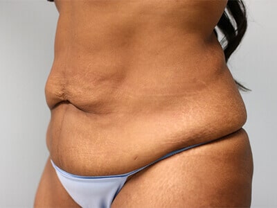 A left-angle view of a patient's body showing the excess skin of her tummy before the surgery