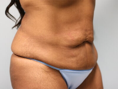A patient's pre-surgery angle of her abdomen wearing sky-blue underwear.