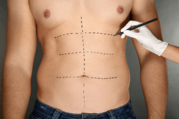 A male torso marked with surgical mapping
