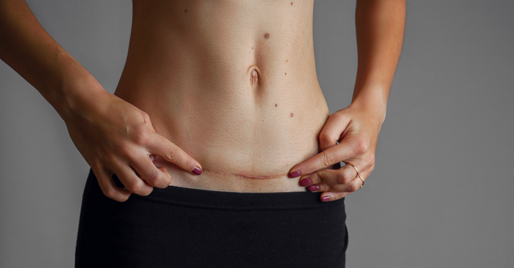 after tummy tuck surgery after a tummy tuck surgery