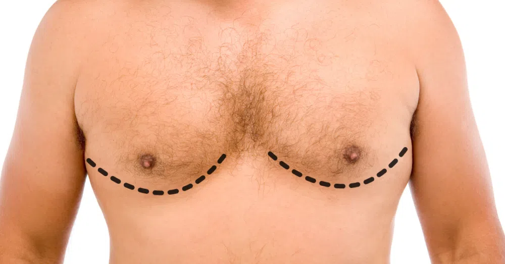 Gynecomastia Surgery