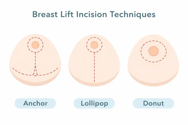 Lollipop Incision Choosing Breast Augmentation vs. Lift | Perimeter Plastic Surgery