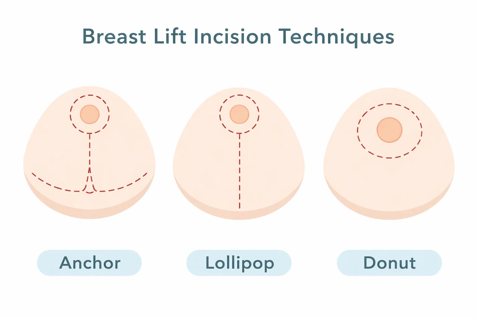 Breast Lift Incisions Techniques Breast Lift Incisions Techniques