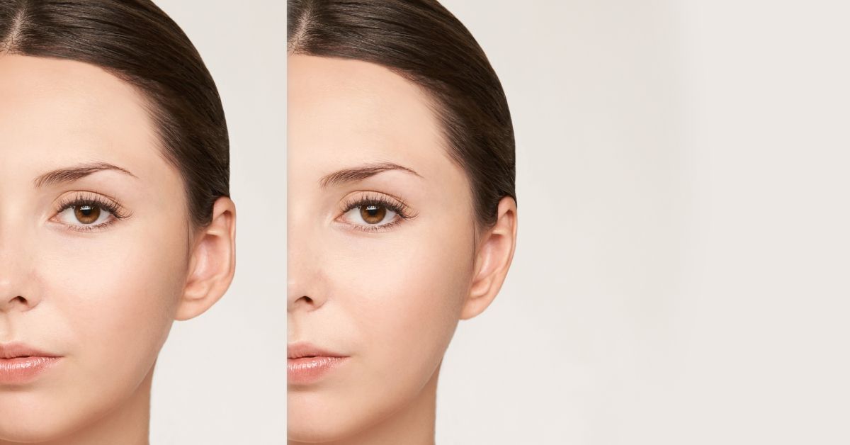 Otoplasty (Ear Shaping)
