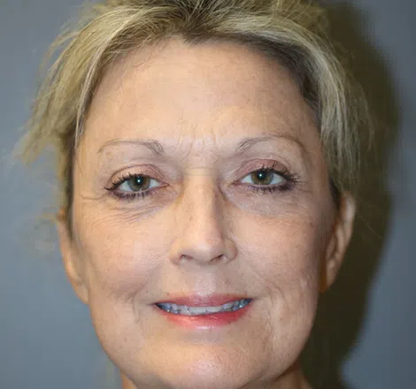 After FLPatient01 Front Atlanta Plastic Surgery - Top Doctor by Atlanta Magazine