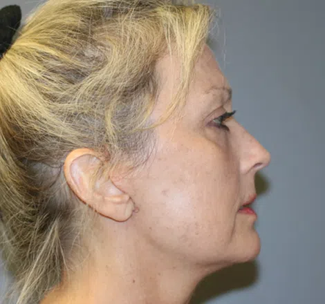 After FLPatient01 Right Atlanta Plastic Surgery - Top Doctor by Atlanta Magazine