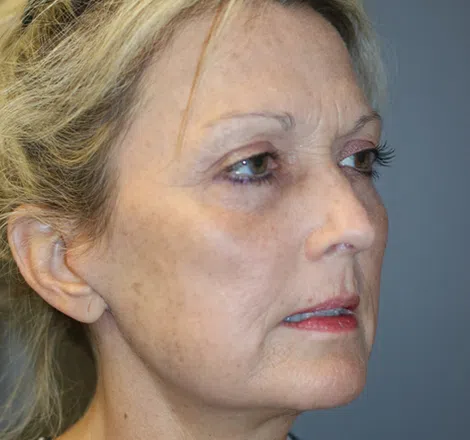 After FLPatient01 RightAngle Atlanta Plastic Surgery - Top Doctor by Atlanta Magazine