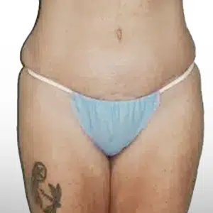 After Patient02 Front Atlanta Plastic Surgery - Top Doctor by Atlanta Magazine