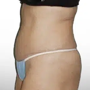 After Patient02 Left Atlanta Plastic Surgery - Top Doctor by Atlanta Magazine