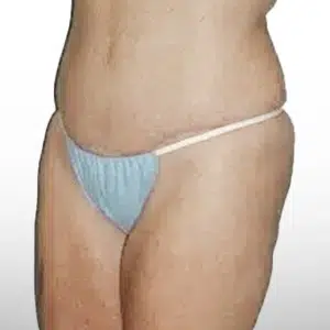 After Patient02 LeftAngle Atlanta Plastic Surgery - Top Doctor by Atlanta Magazine