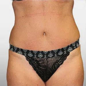 After Patient03 Front Atlanta Plastic Surgery - Top Doctor by Atlanta Magazine