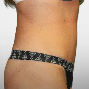 After Patient03 Right Atlanta Plastic Surgery - Top Doctor by Atlanta Magazine