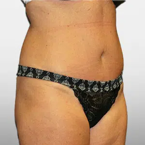 After Patient03 RightAngle Atlanta Plastic Surgery - Top Doctor by Atlanta Magazine