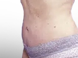 After Patient04 Left Atlanta Plastic Surgery - Top Doctor by Atlanta Magazine